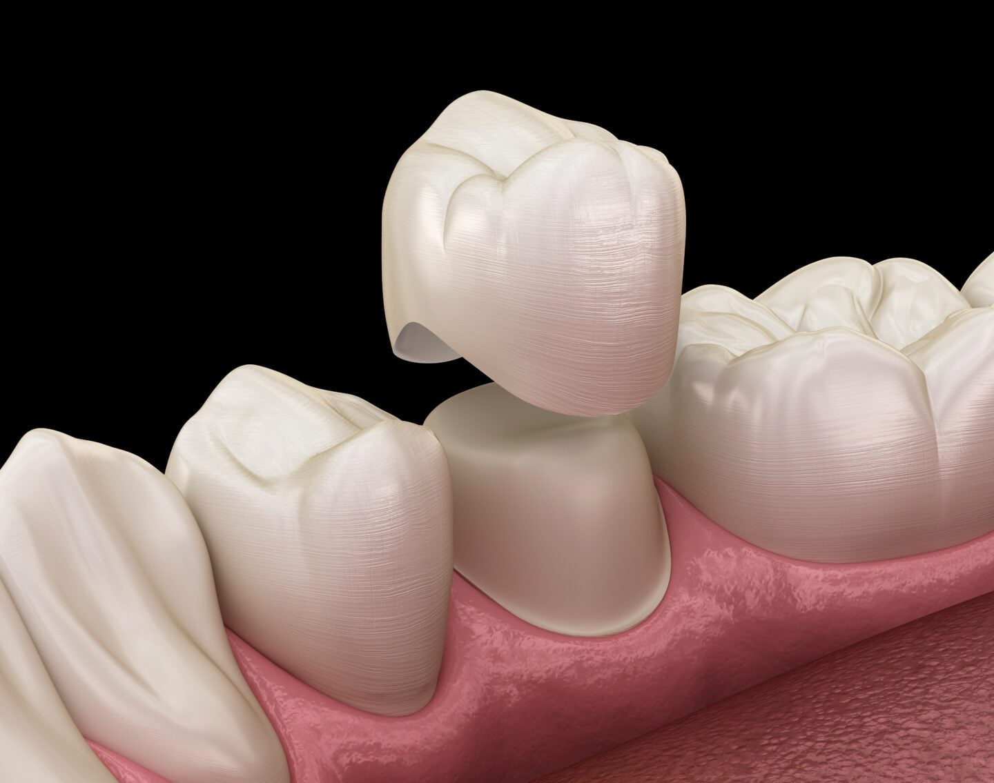 dental crowns in Huntsville